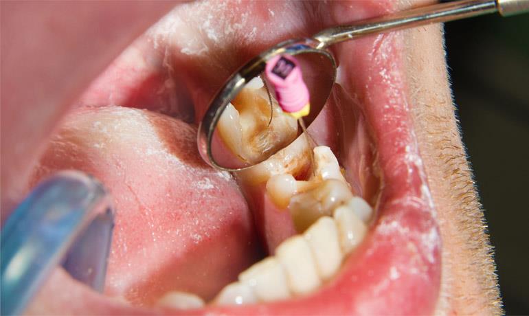 علاج-جذر-الأسنان