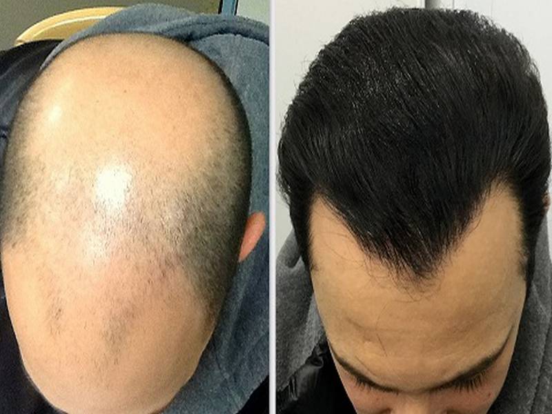 Iran Medical Tourism Hair Transplant Image