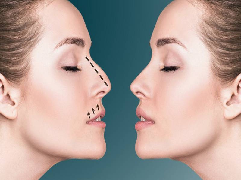 Iran Medical Tourism offering Rhinoplasty services.